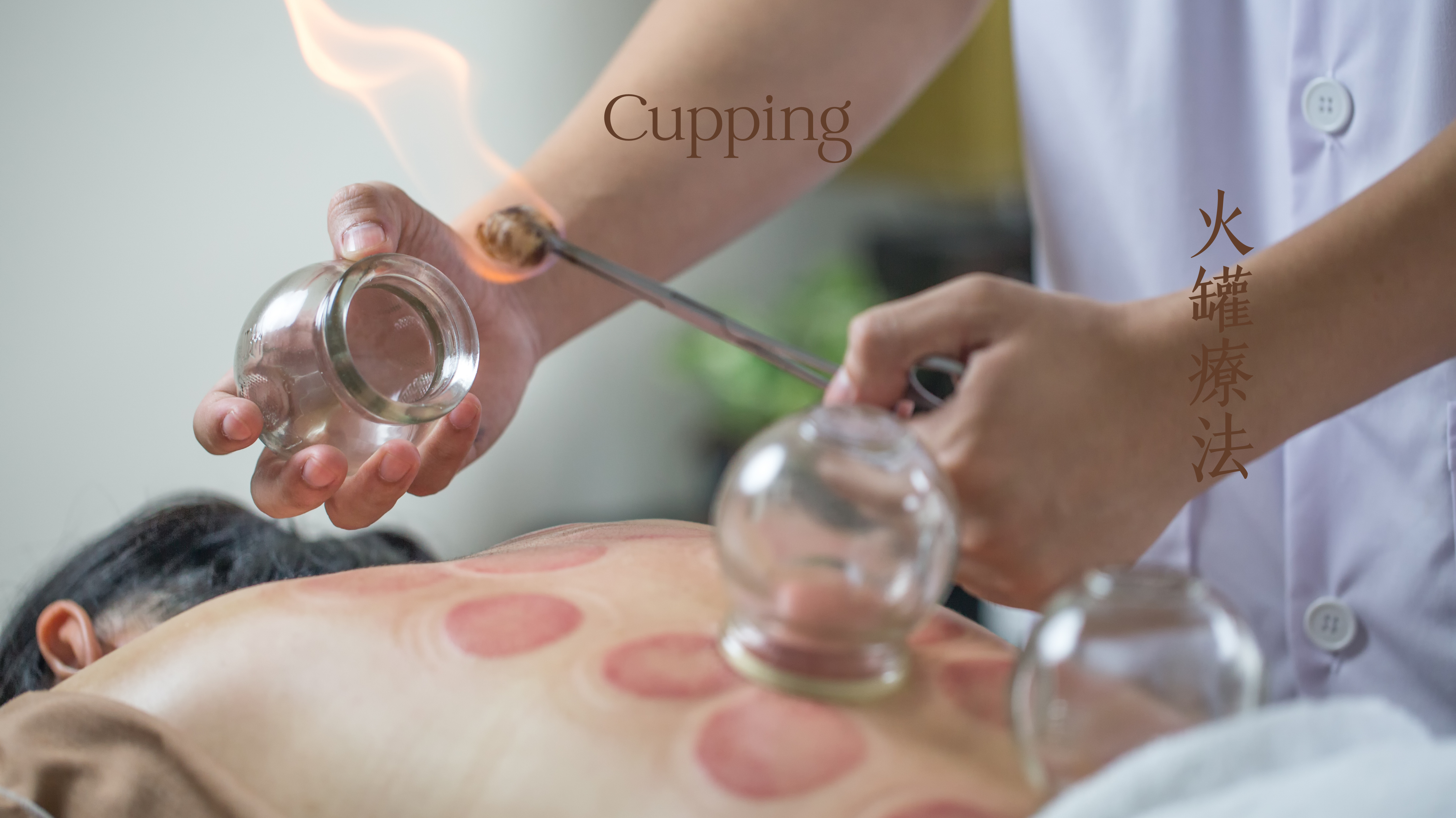 Cupping Therapy(拔罐療法）