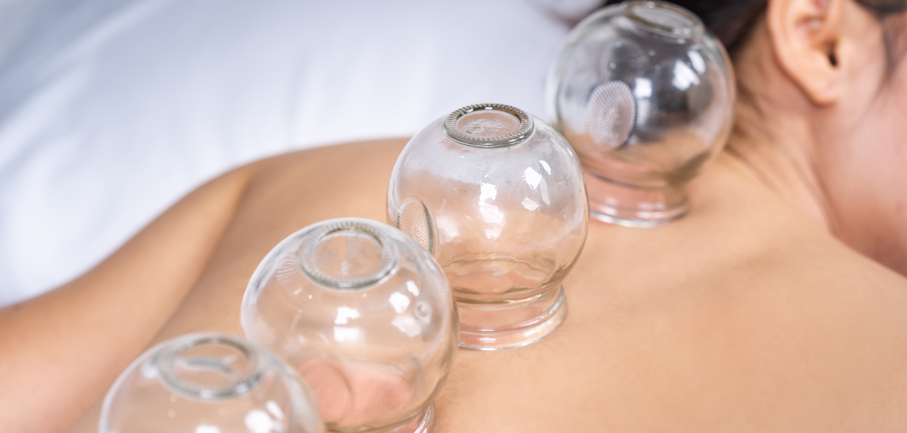 Cupping Therapy 拔罐