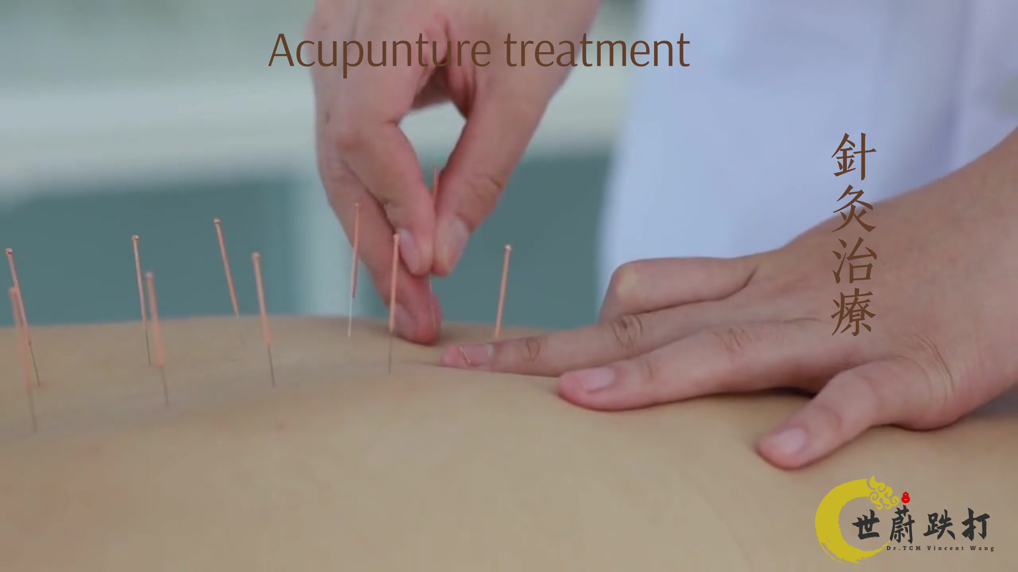 針灸（Acupuncture）的治疗作用？