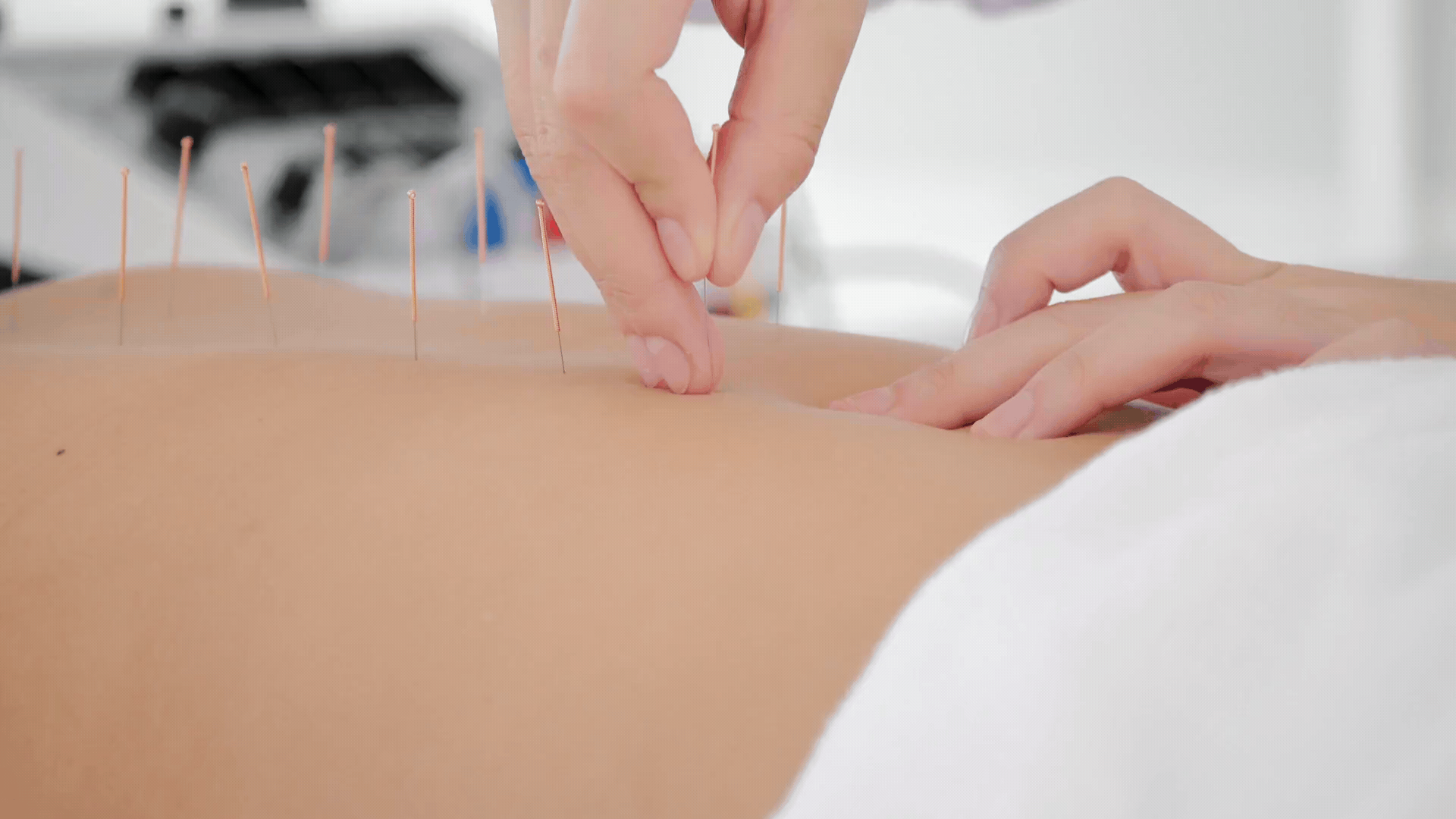 針灸的治療作用？