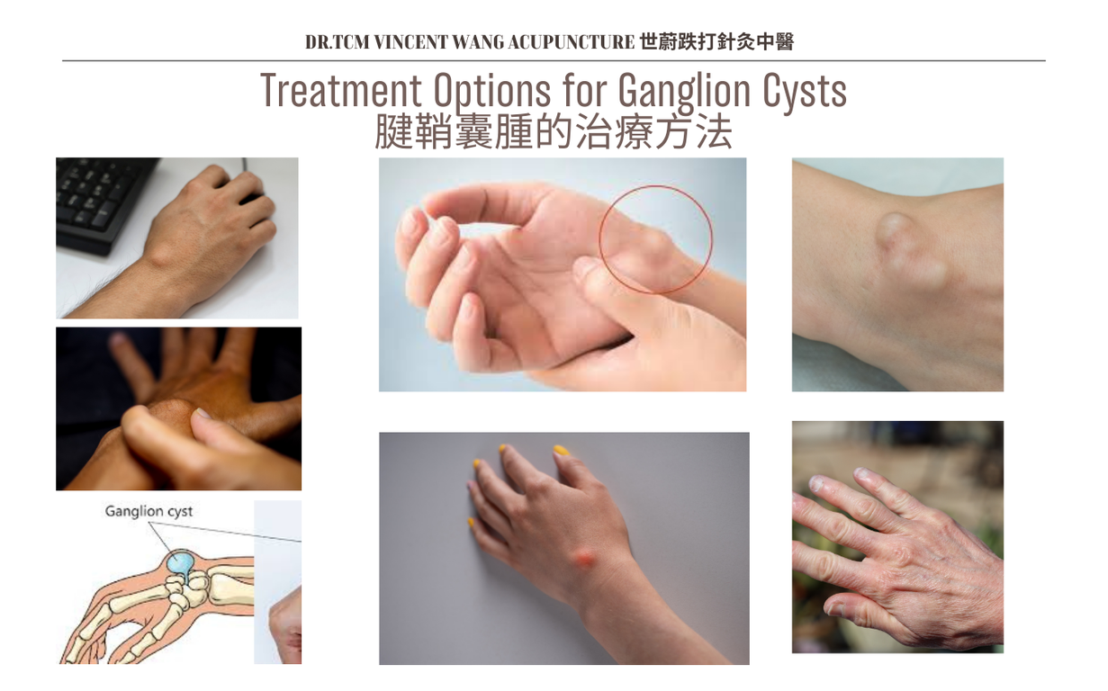 腱鞘囊腫的治療方法 Treatment Options for Ganglion Cysts