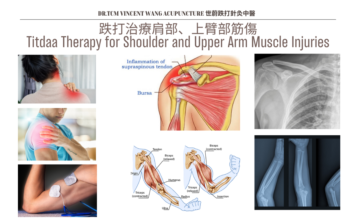 肱二頭肌長頭肌腱炎 (Biceps Long Head Tendonitis)