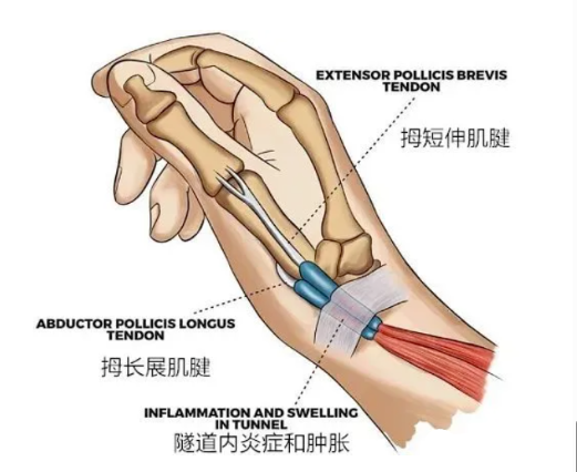 妈妈手 桡骨茎突炎 手腕拇指疼痛